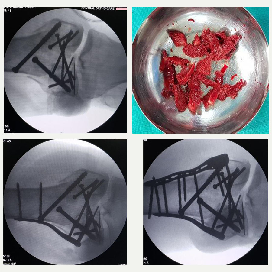 Highly comminuted knee fracture management