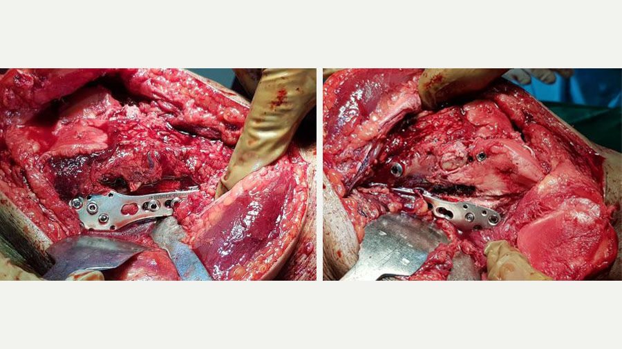 Highly comminuted knee fracture management