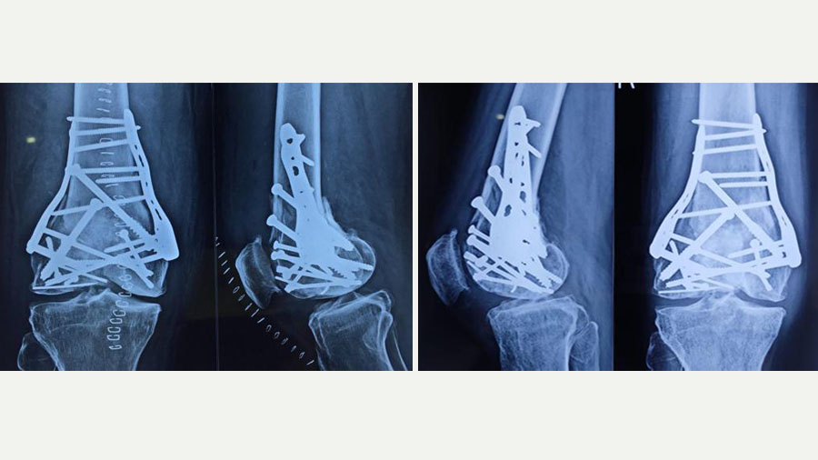 Fig 06 highly comminuted knee fracture