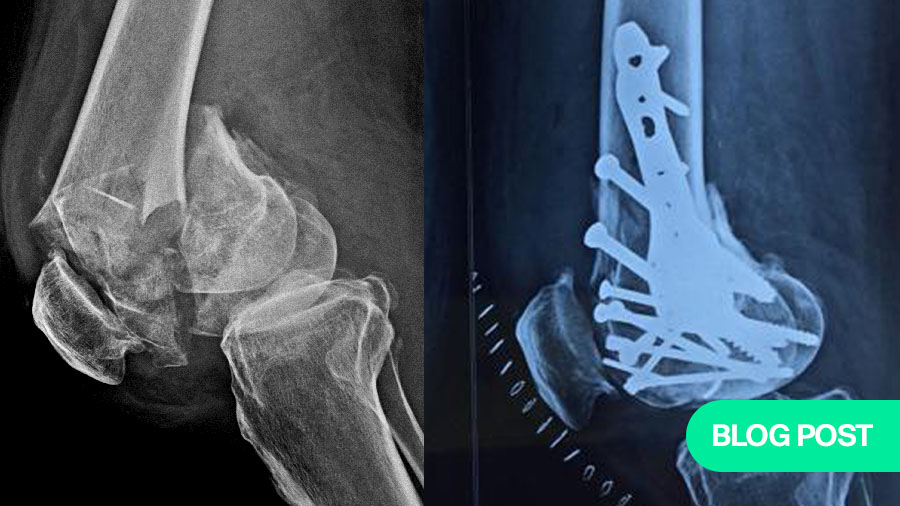 Reconstructing a shattered knee: A case study in complex intra-articular fracture management