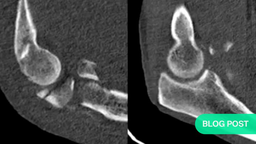 Subluxation after terrible triad fixation: key insights and solutions