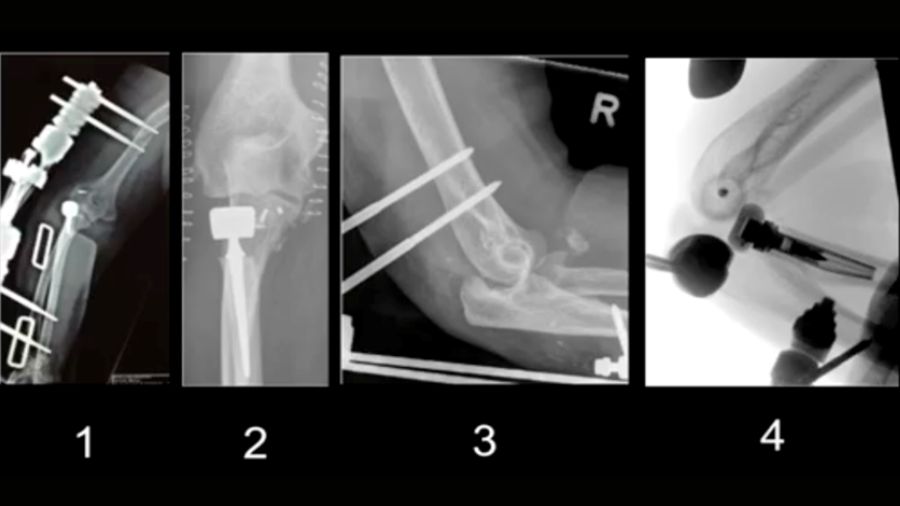 Subluxation after terrible triad fixation: key insights and