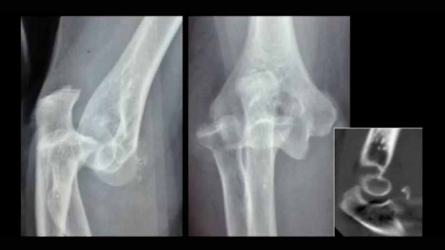 overstuffed radial head prosthesis causing subluxation