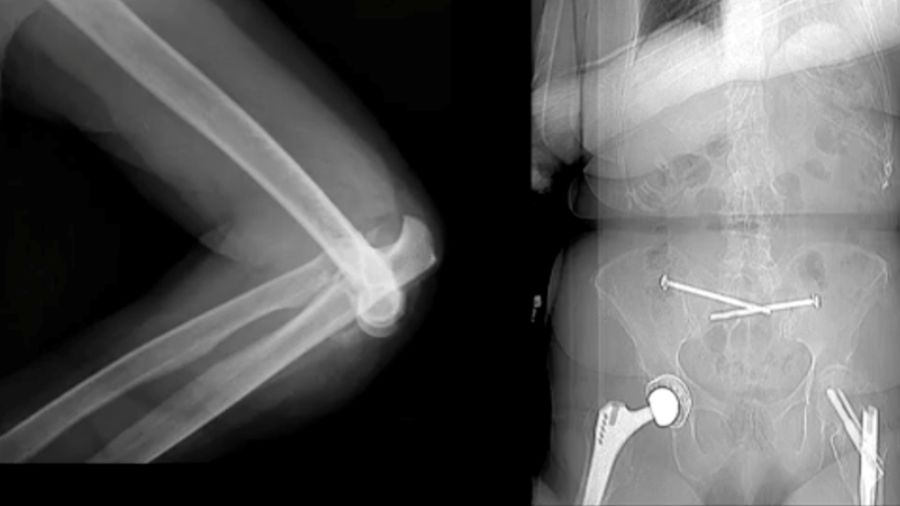 total elbow prosthesis highlighting the complexities of managing such advanced injuries in older patients