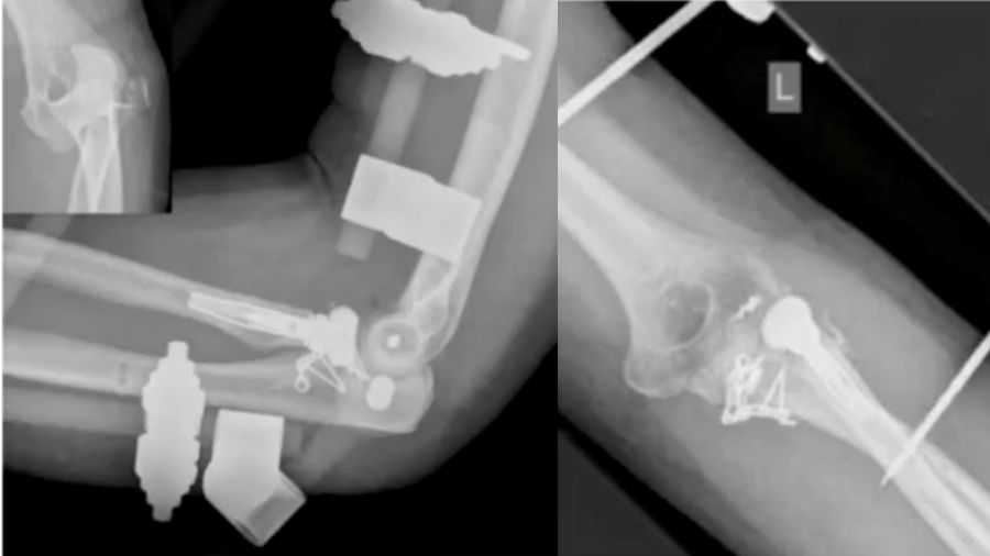 luxated elbow, radial head fracture, and coronoid fracture; improper positioning of the radius head and a lateral shift in the elbow