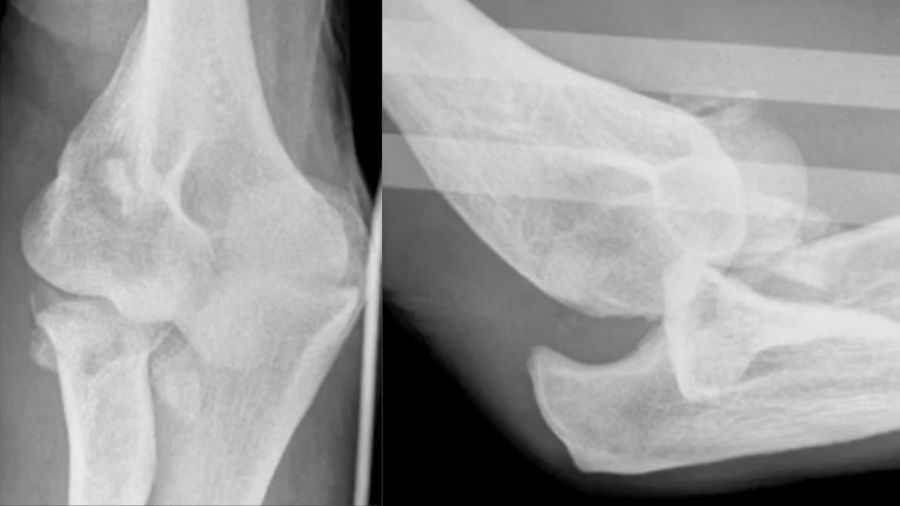 athlete with a comminuted coronoid fracture and severely damaged radial head 