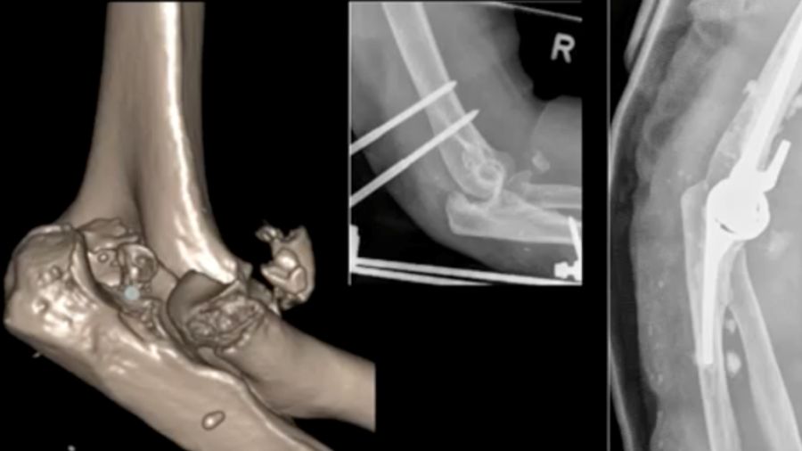 a terrible triad had an external fixator. A cemented prosthesis  encountered complications with cement leakage