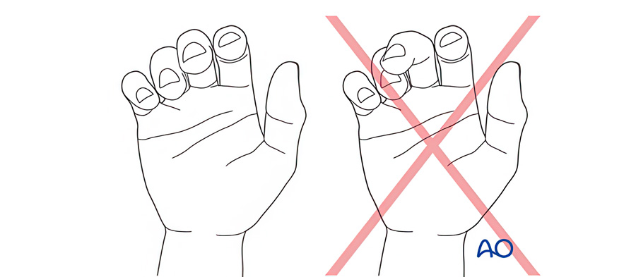 Metacarpal Fractures: Avoiding Malunion and Stiffness