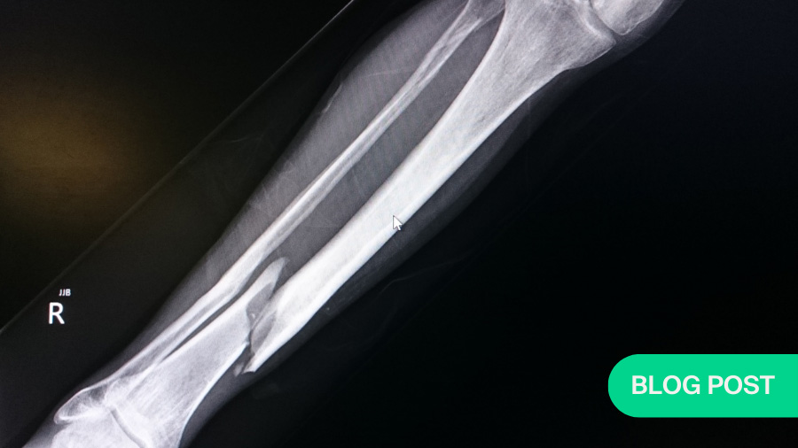 Fracture recovery: what biomarkers tell us long before the bone appears healed