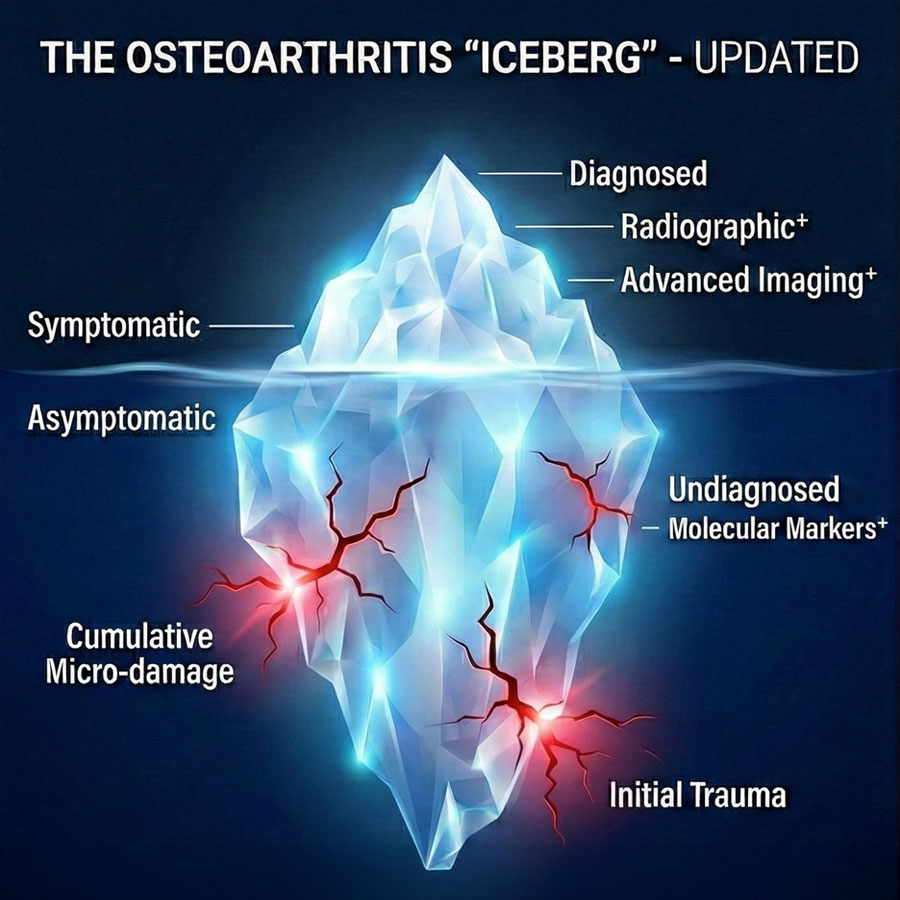 Predicting post-traumatic osteoarthritis after intra-articular injury