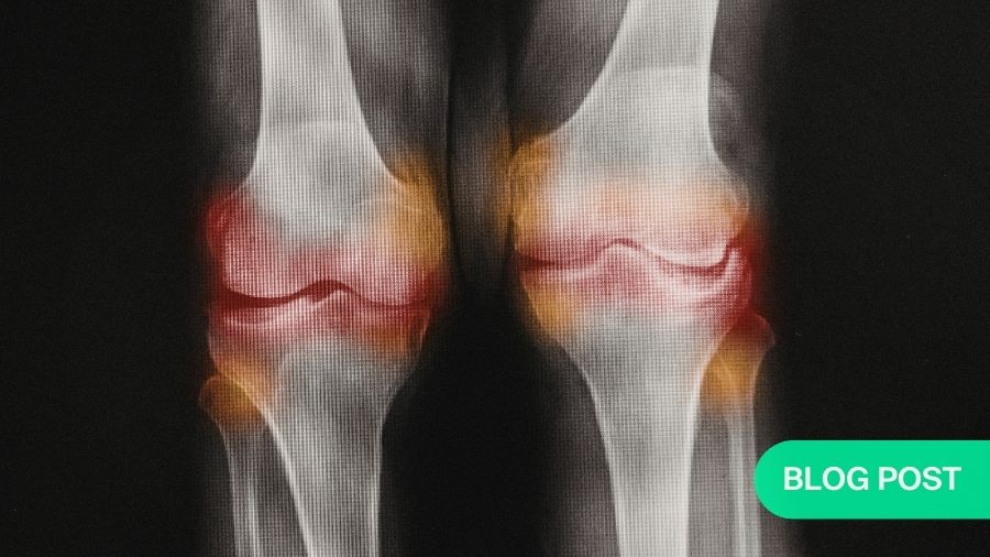 Beyond union: predicting post-traumatic osteoarthritis after intra-articular injury