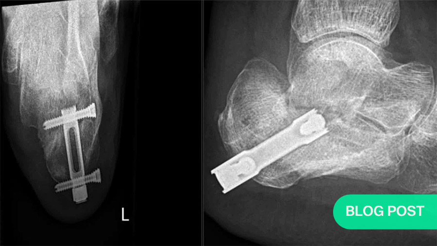 Blog Calcaneal