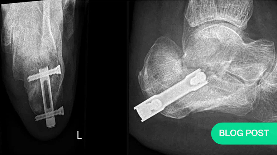 For  calcaneal fractures, approach and fixation decisions rely on soft tissue healing potential