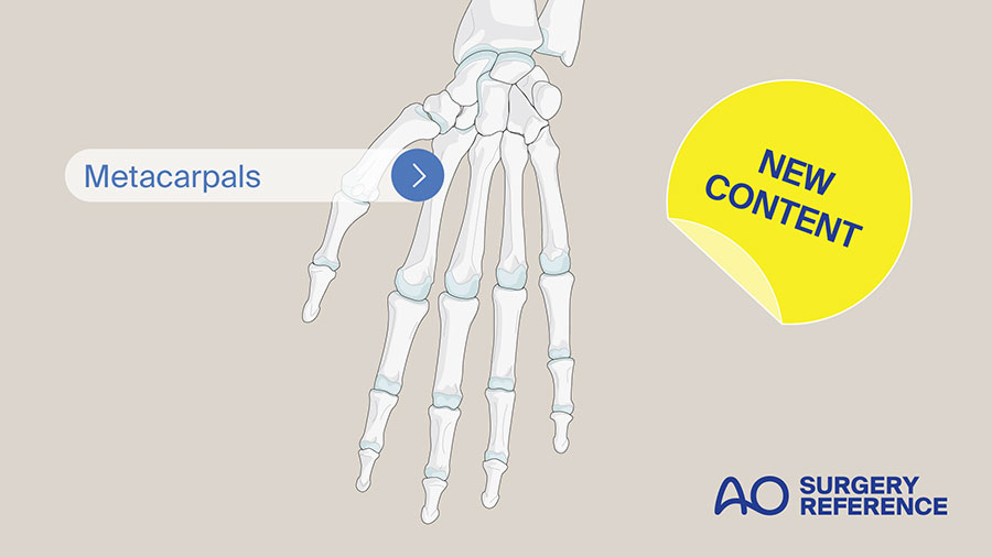 Metacarpals