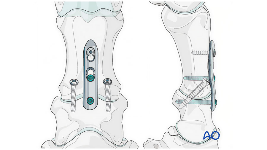 Pastern Arthrodesis in the horse: Current Controversies