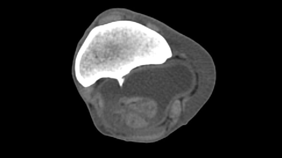 Understanding the physeal spike complex in equine athletes