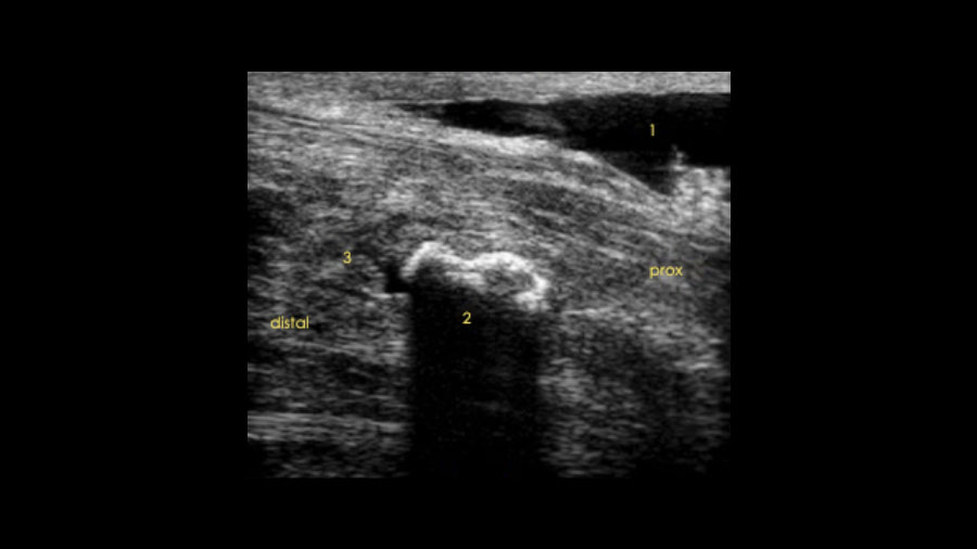 Understanding the physeal spike complex in equine athletes