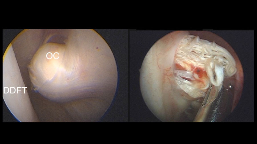 Understanding the physeal spike complex in equine athletes