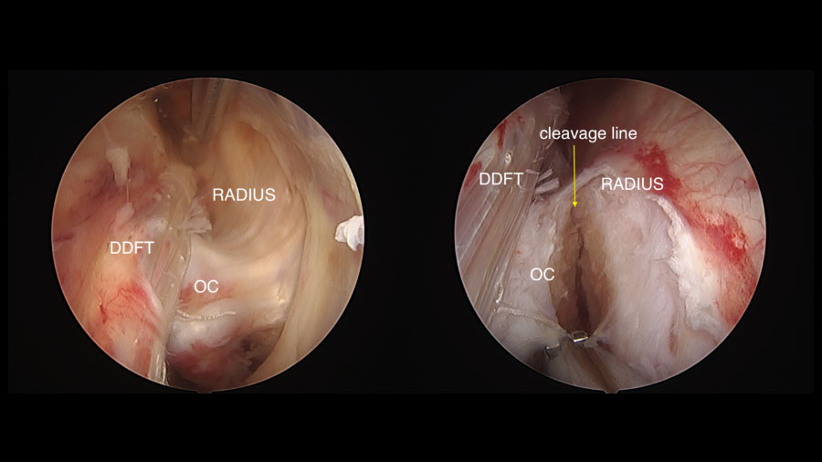 Understanding the physeal spike complex in equine athletes