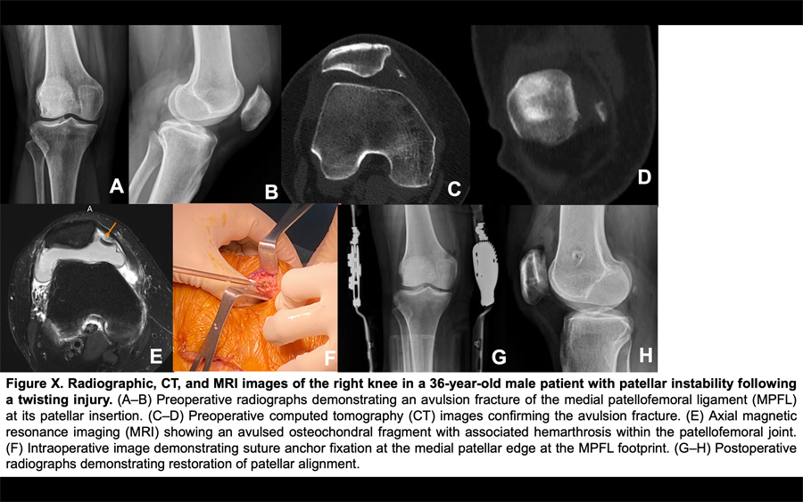 Comprehensive patellar luxation in humans, horses, and dogs